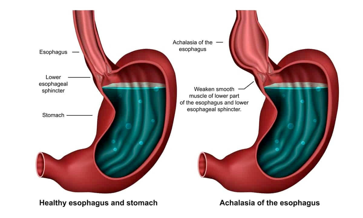 Esophageal Achalasia